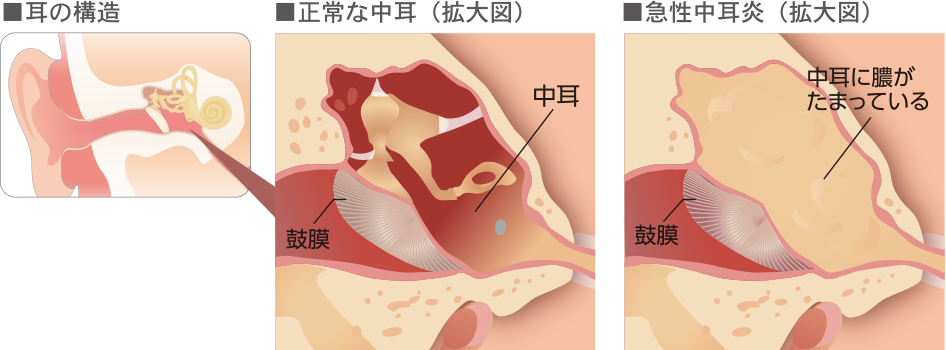 赤ちゃん 耳 の 後ろ しこり