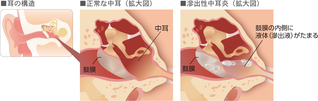 みみの症状 子どもの救急 病気 坂井耳鼻咽喉科 キッズサイト 愛知県春日井市 耳鼻科