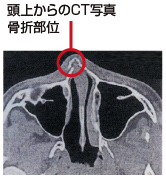 はなの症状 子どもの救急 病気 坂井耳鼻咽喉科 キッズサイト 愛知県春日井市 耳鼻科