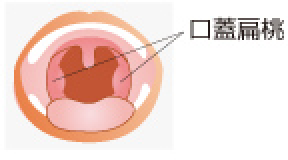 アデノイド肥大 イラスト01