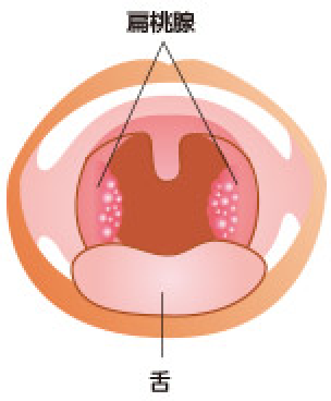 ボコボコ 扁桃 腺