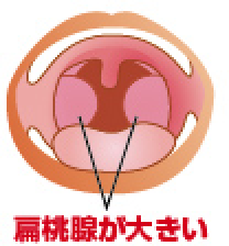 のどの症状 子どもの救急 病気 坂井耳鼻咽喉科 キッズサイト 愛知県春日井市 耳鼻科