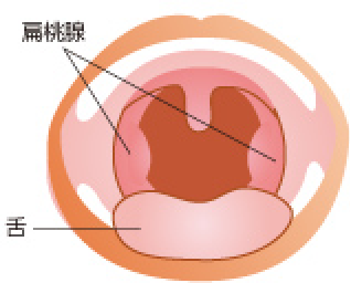 腺 でき 扁桃 もの 白い